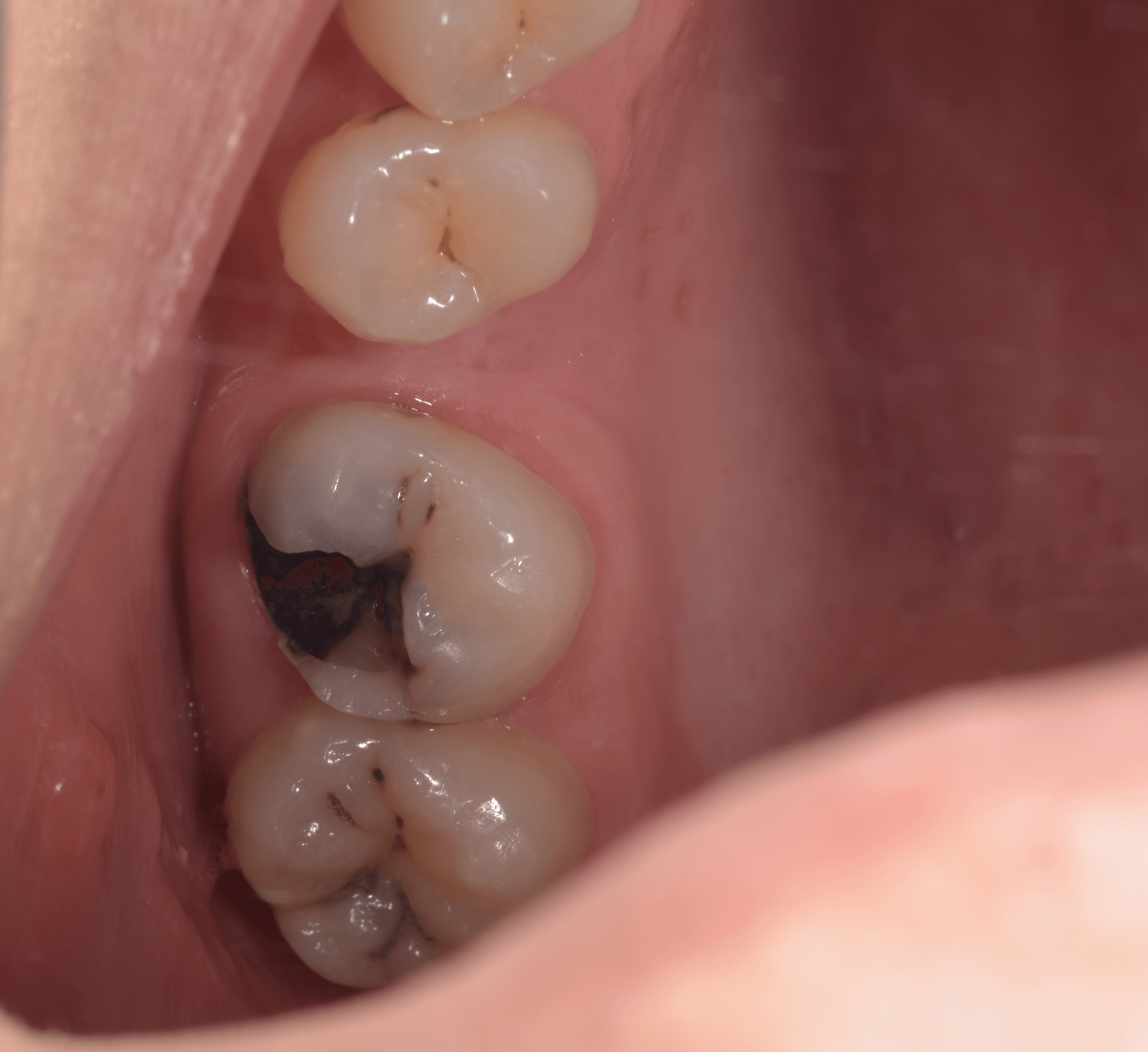 ترميم تجميلي لضرس — قبل