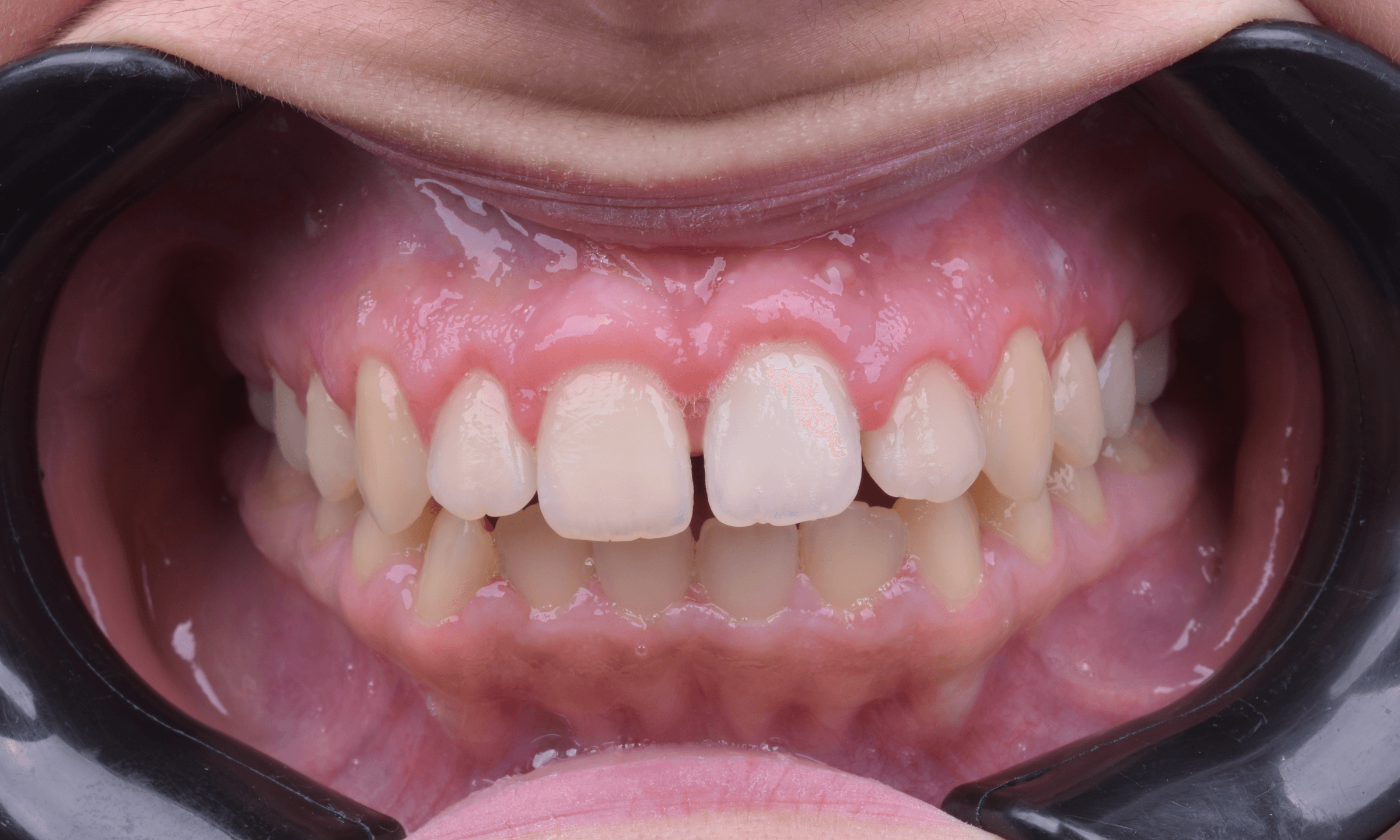 Orthodontic treatment progress · Case 01 — Follow-up