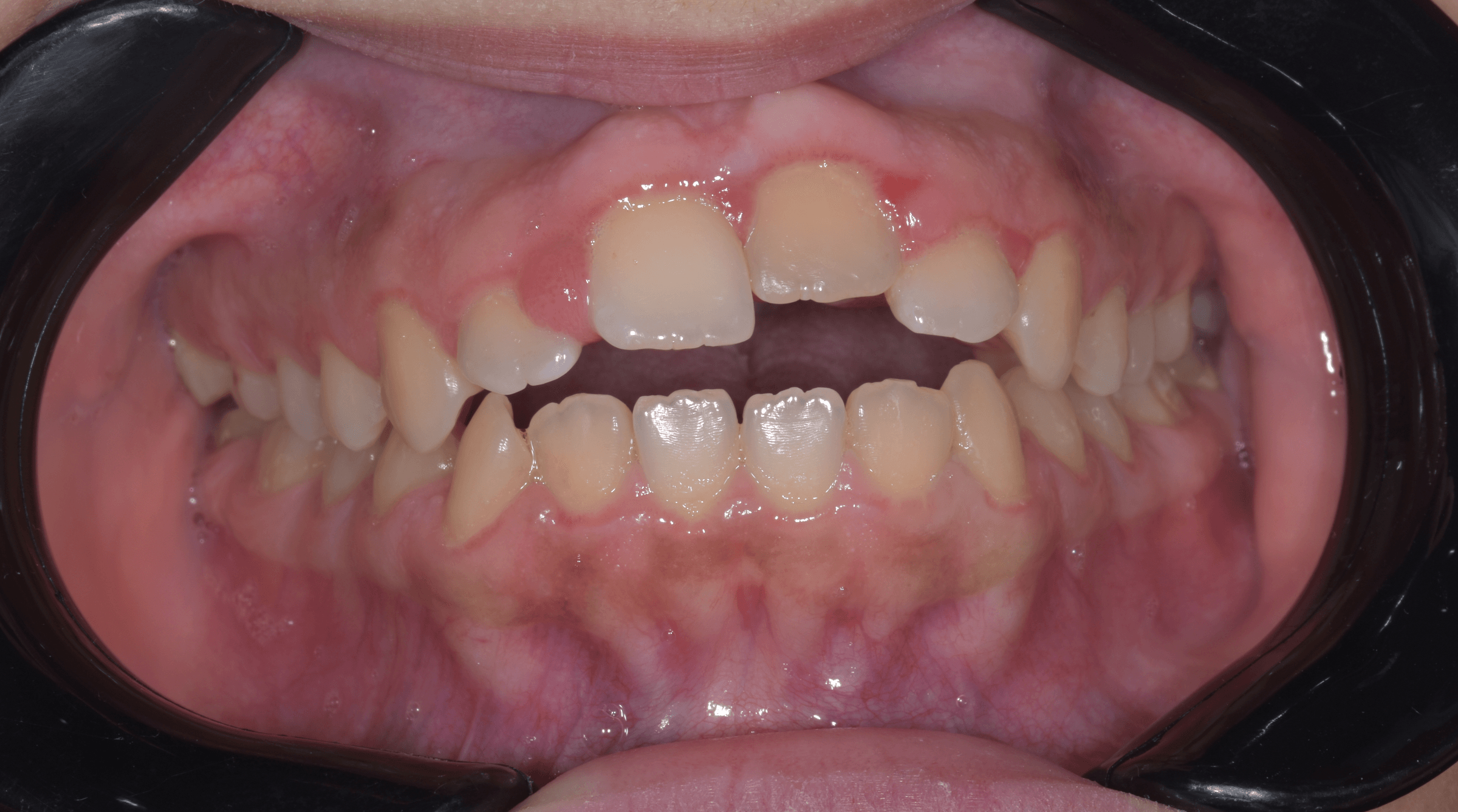 Orthodontic treatment progress · Case 01 — Initial view