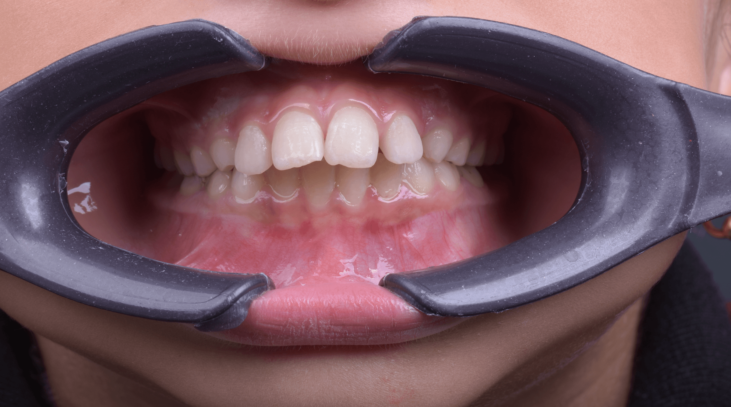 Orthodontic treatment progress · Case 02 — Follow-up