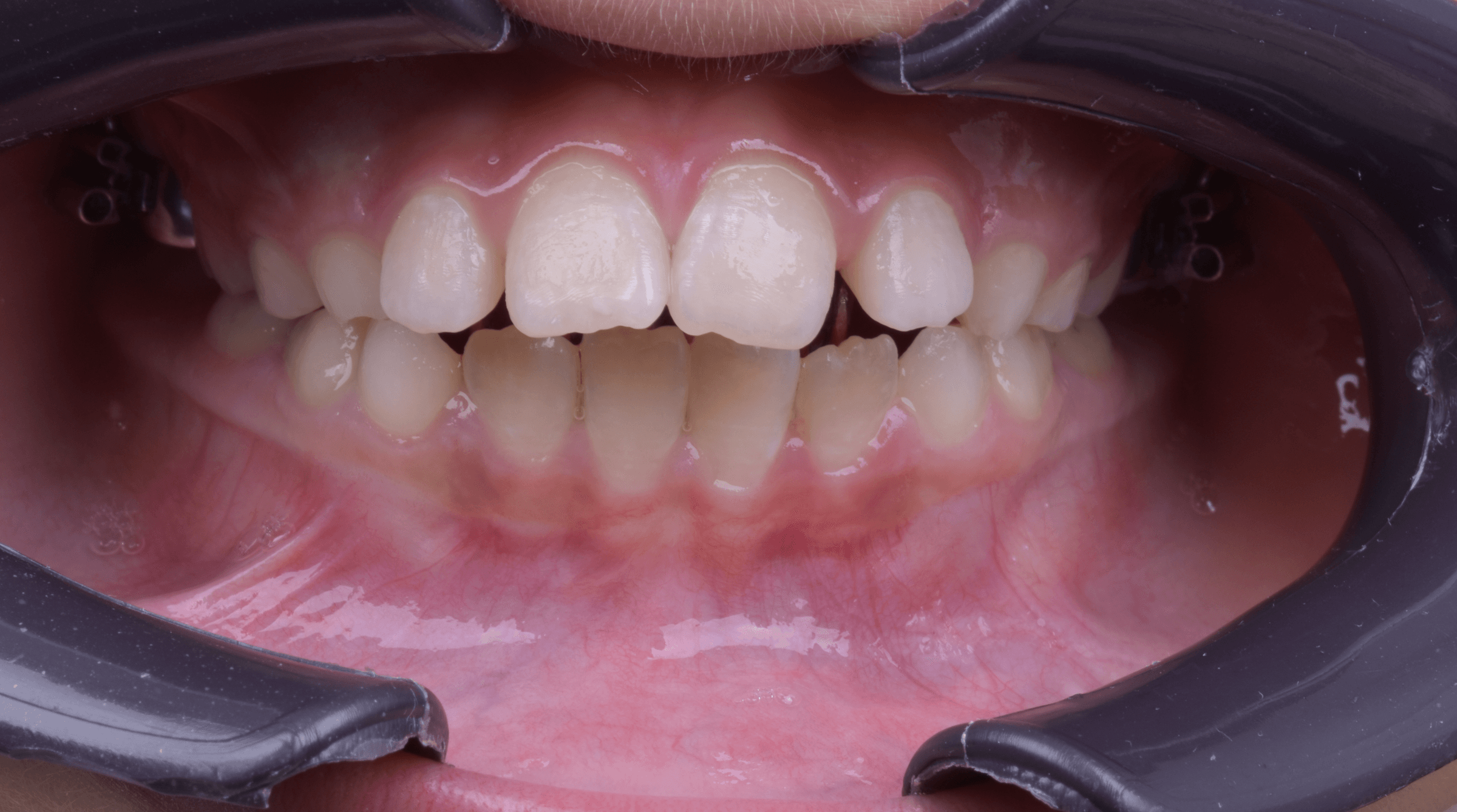 Orthodontic treatment progress · Case 02 — Initial view