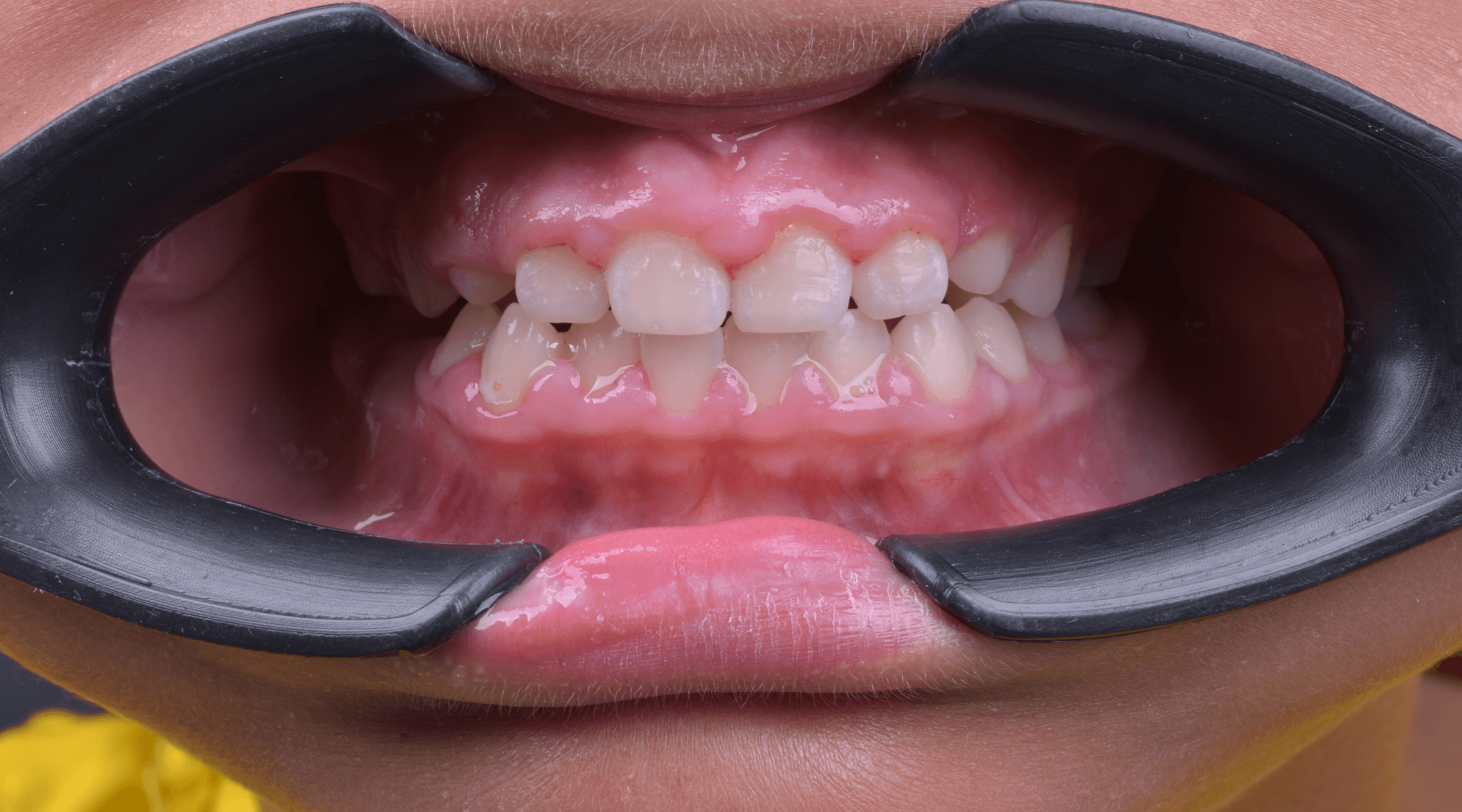 Orthodontic treatment progress · Case 03 — Follow-up