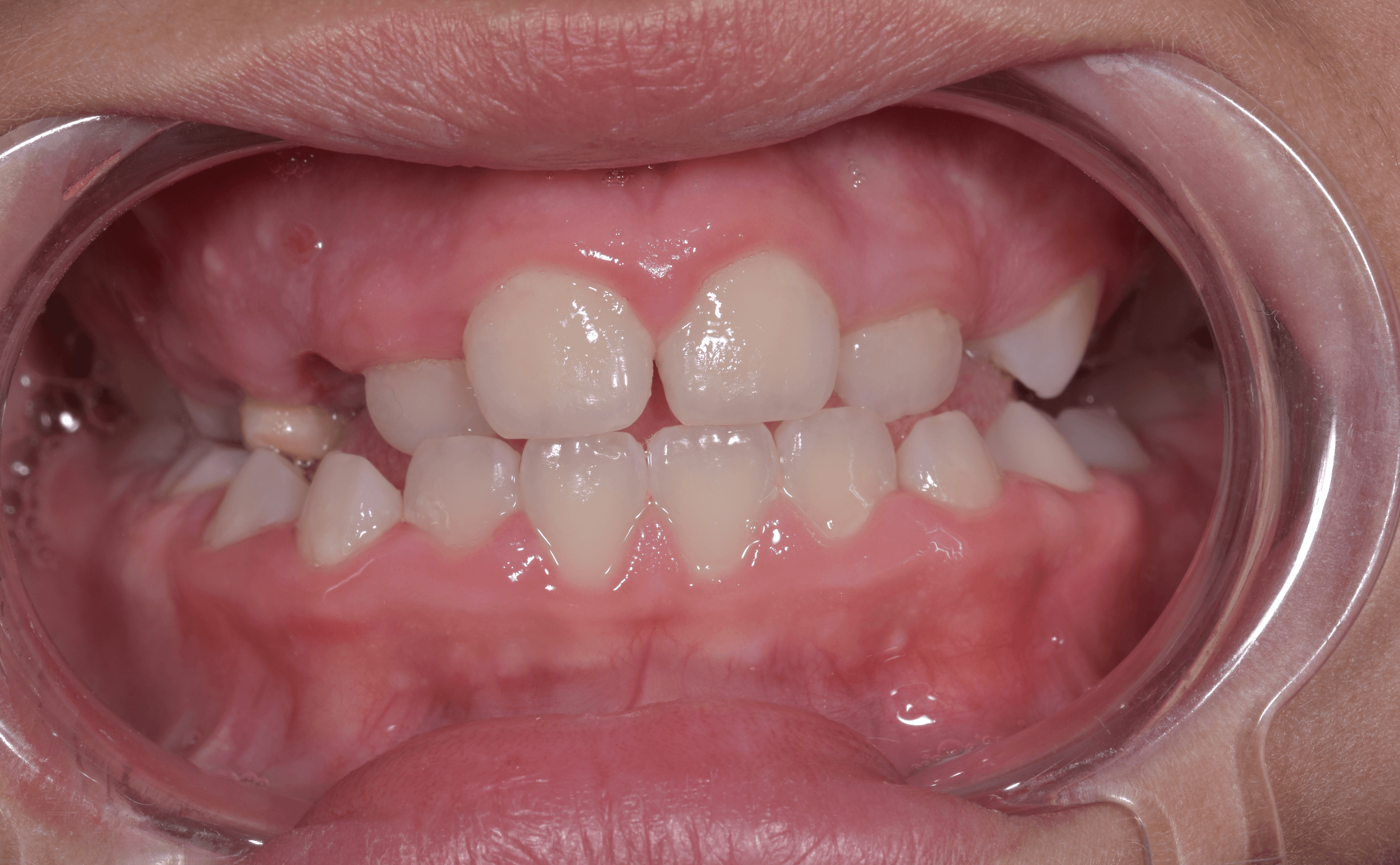 Orthodontic treatment progress · Case 03 — Initial view