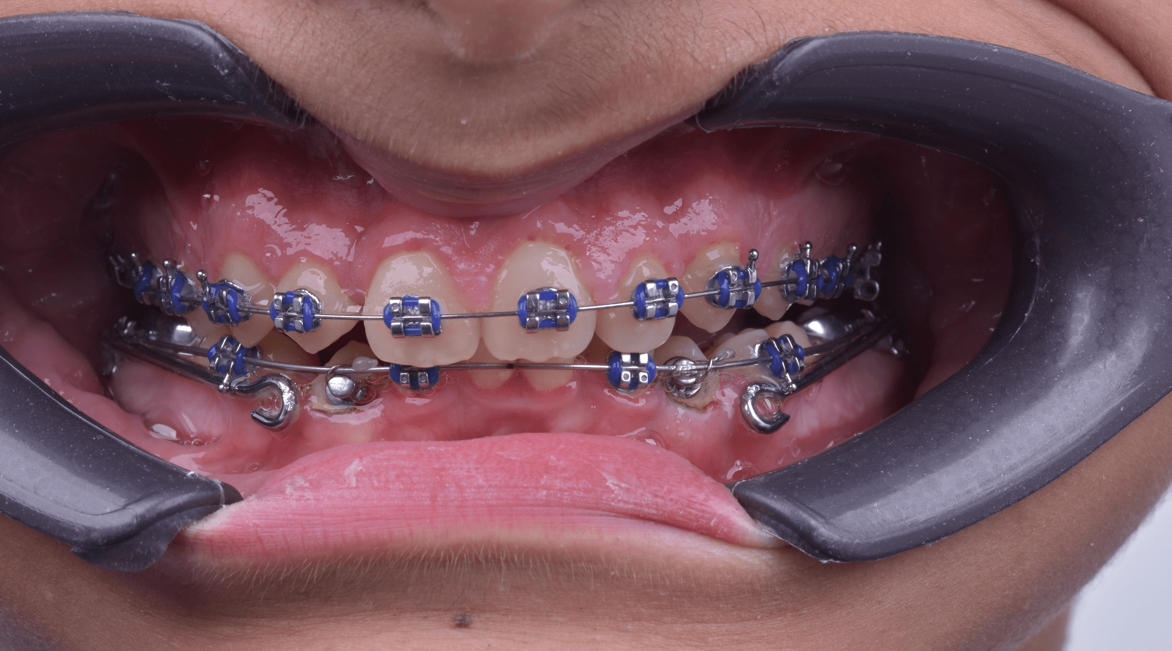 Orthodontic treatment progress · Case 04 — Follow-up