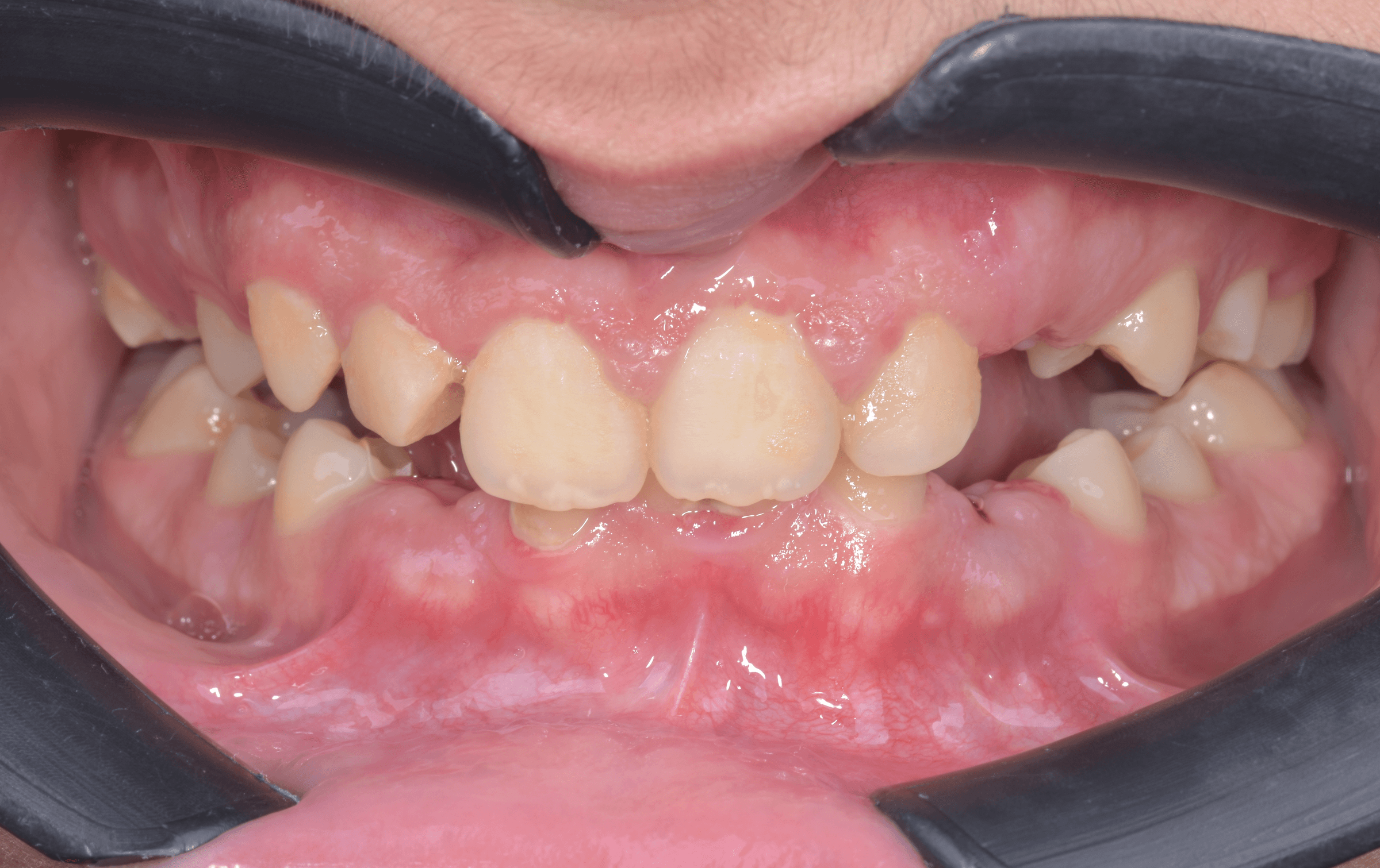 Orthodontic treatment progress · Case 04 — Initial view