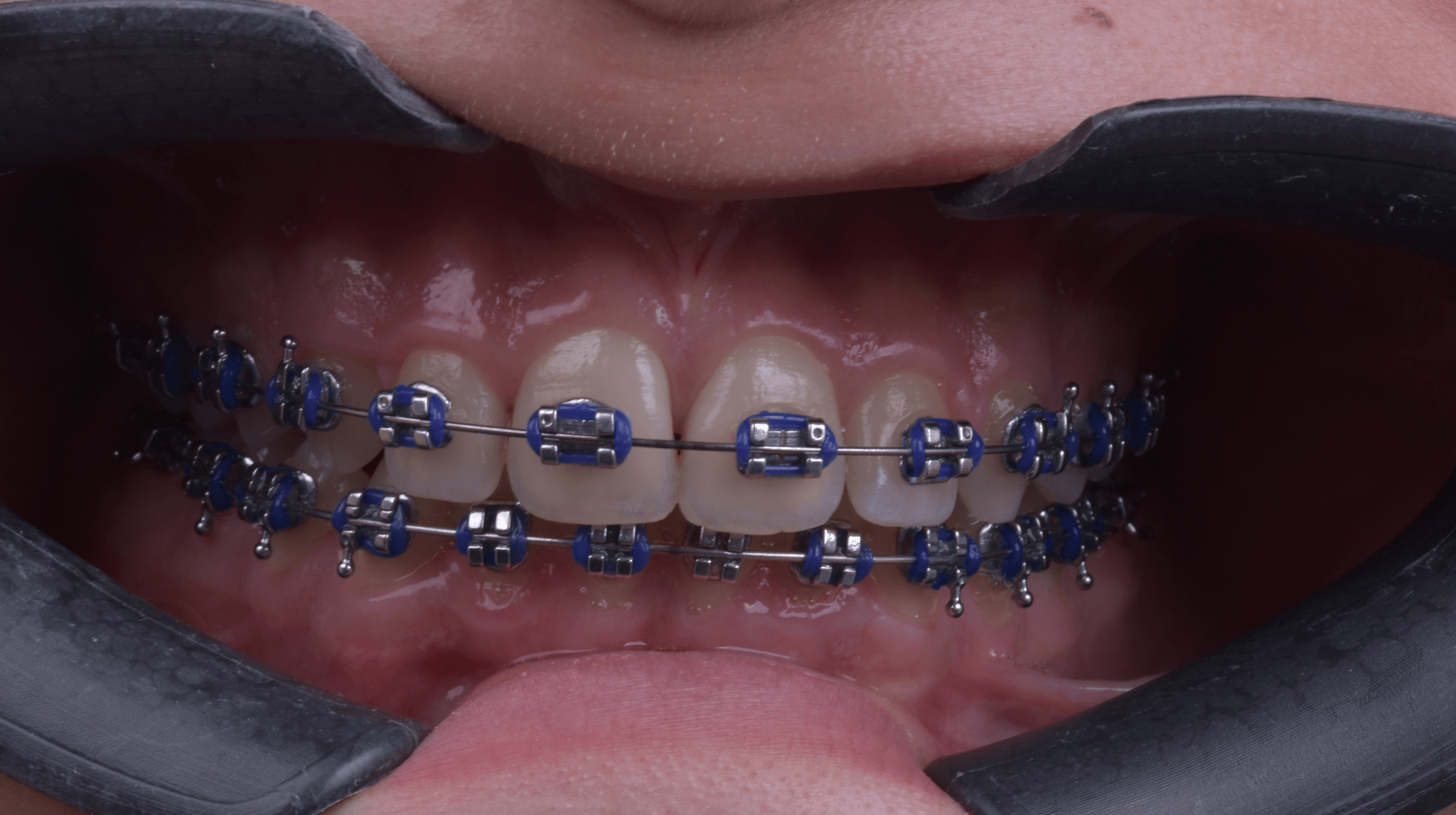 Orthodontic treatment progress · Case 05 — Follow-up