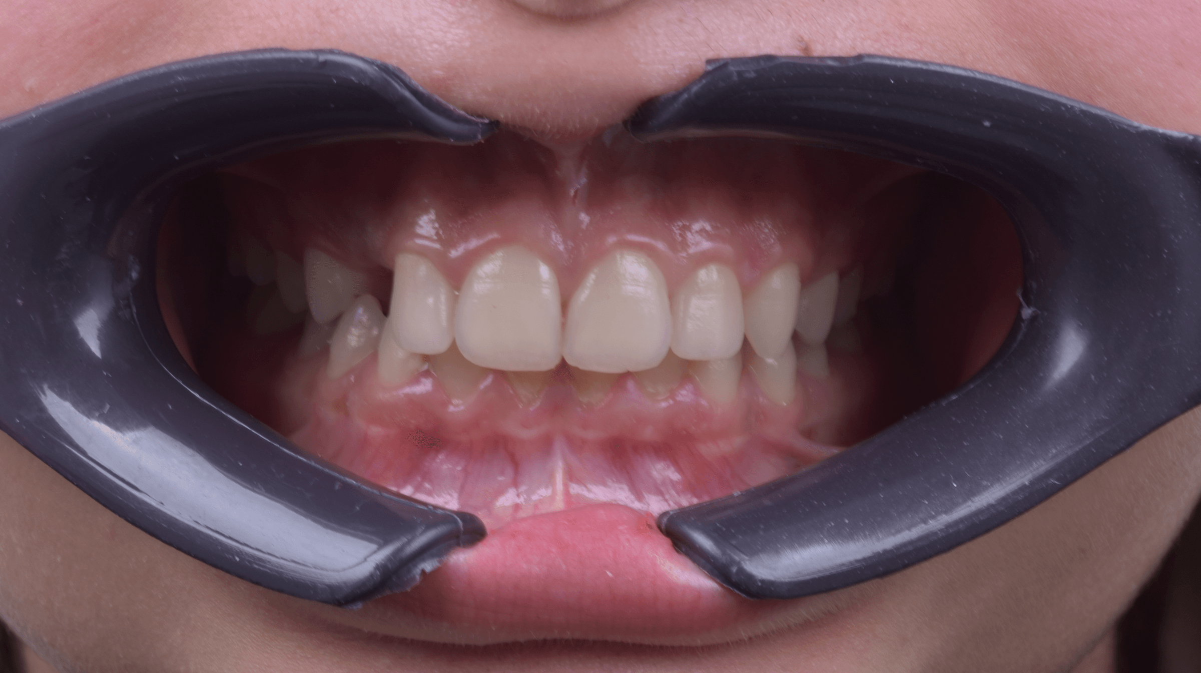 Orthodontic treatment progress · Case 05 — Initial view