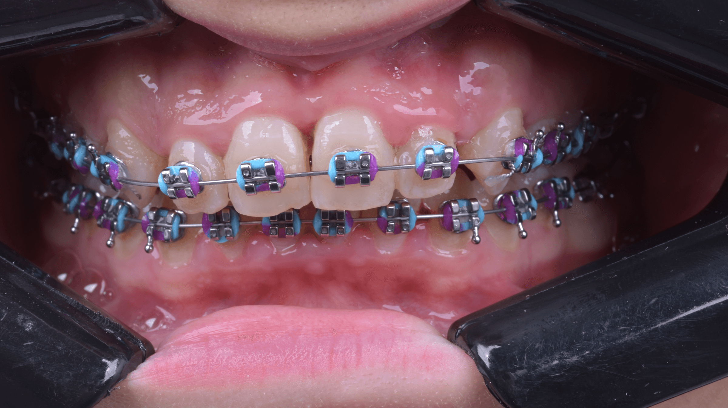 Orthodontic treatment progress · Case 06 — Follow-up