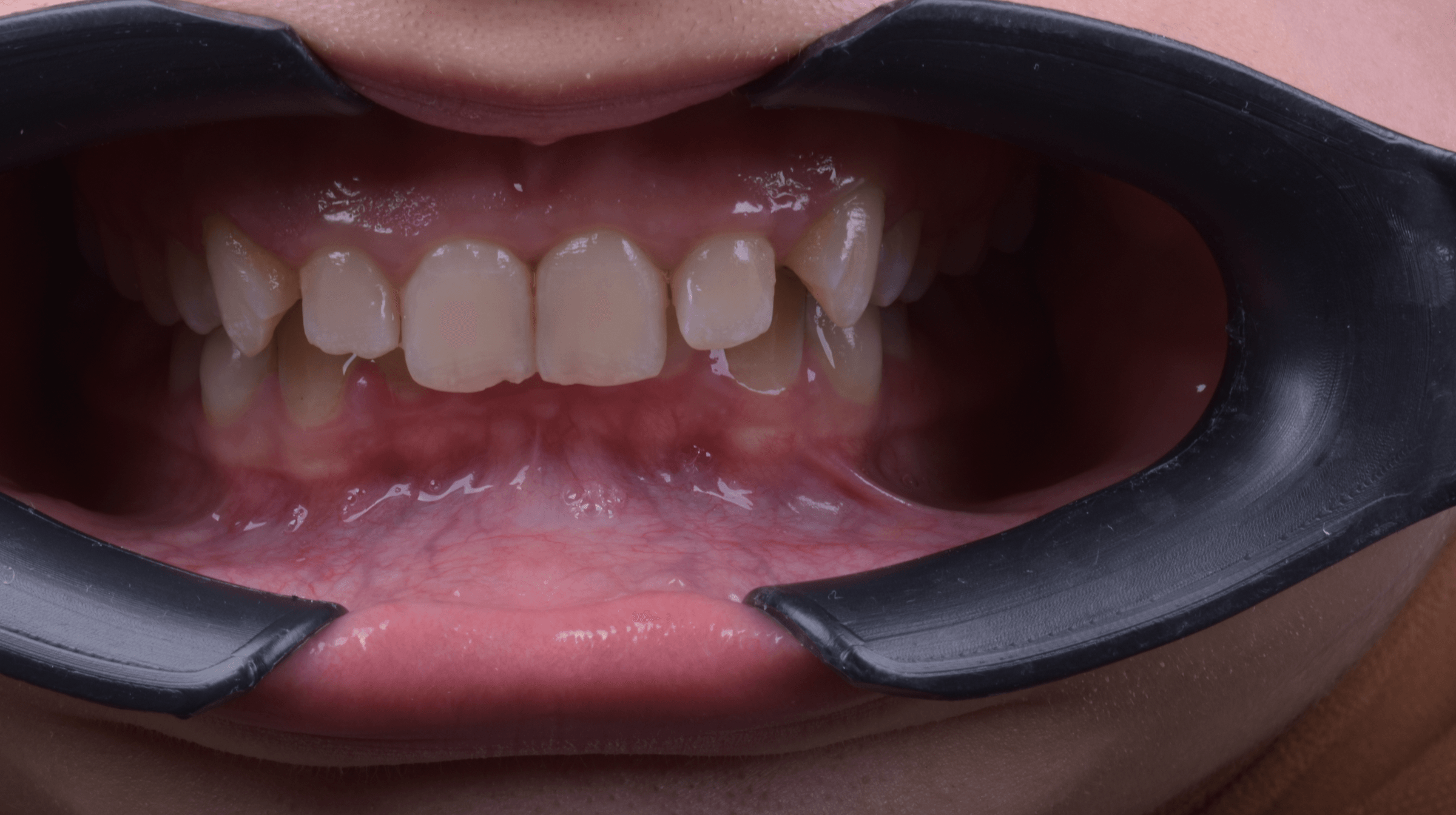 Orthodontic treatment progress · Case 06 — Initial view
