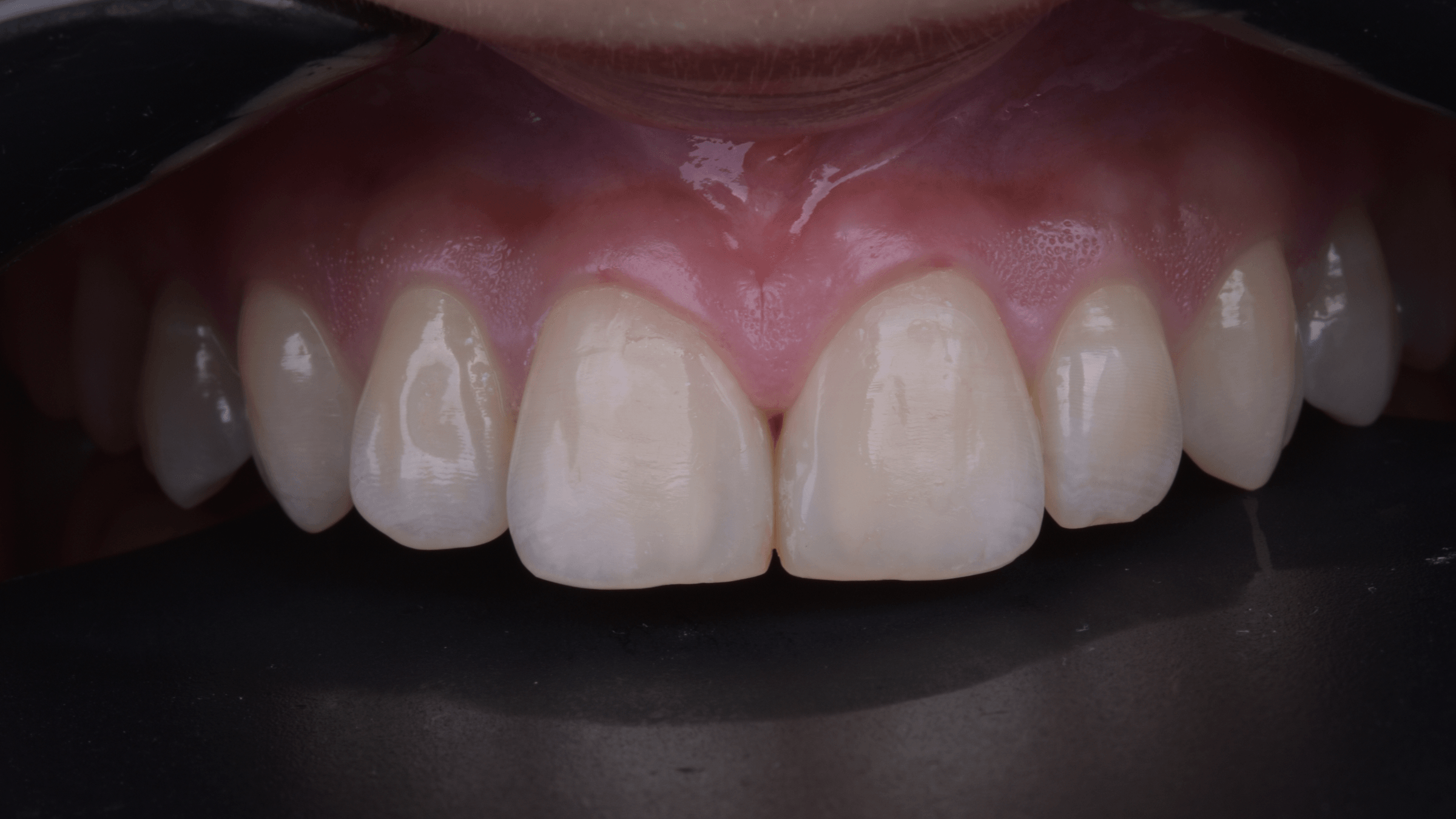 تجميل الأسنان الأمامية — بعد