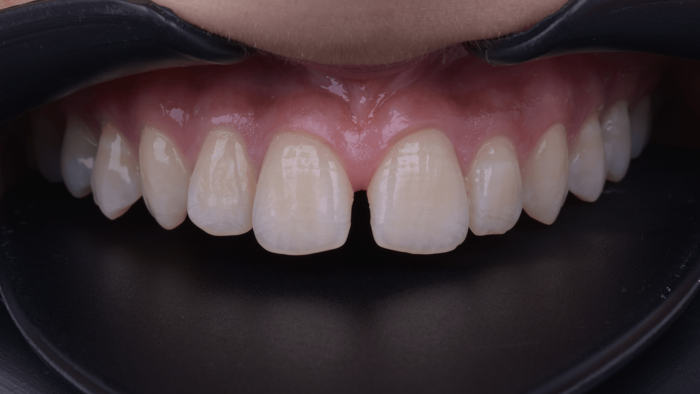 تجميل الأسنان الأمامية — قبل