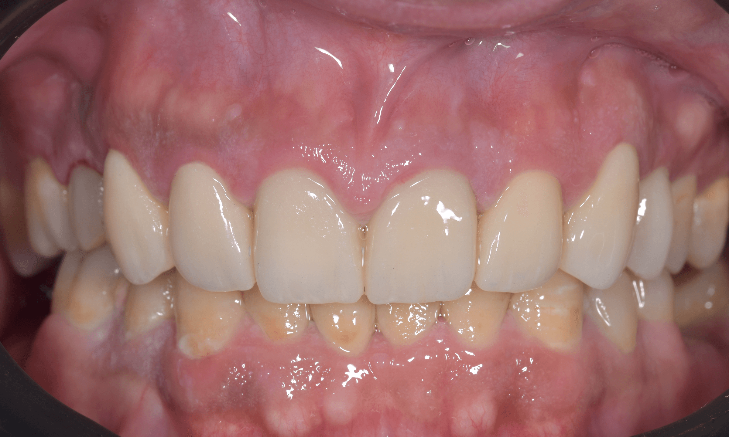 Restoring the front teeth — After