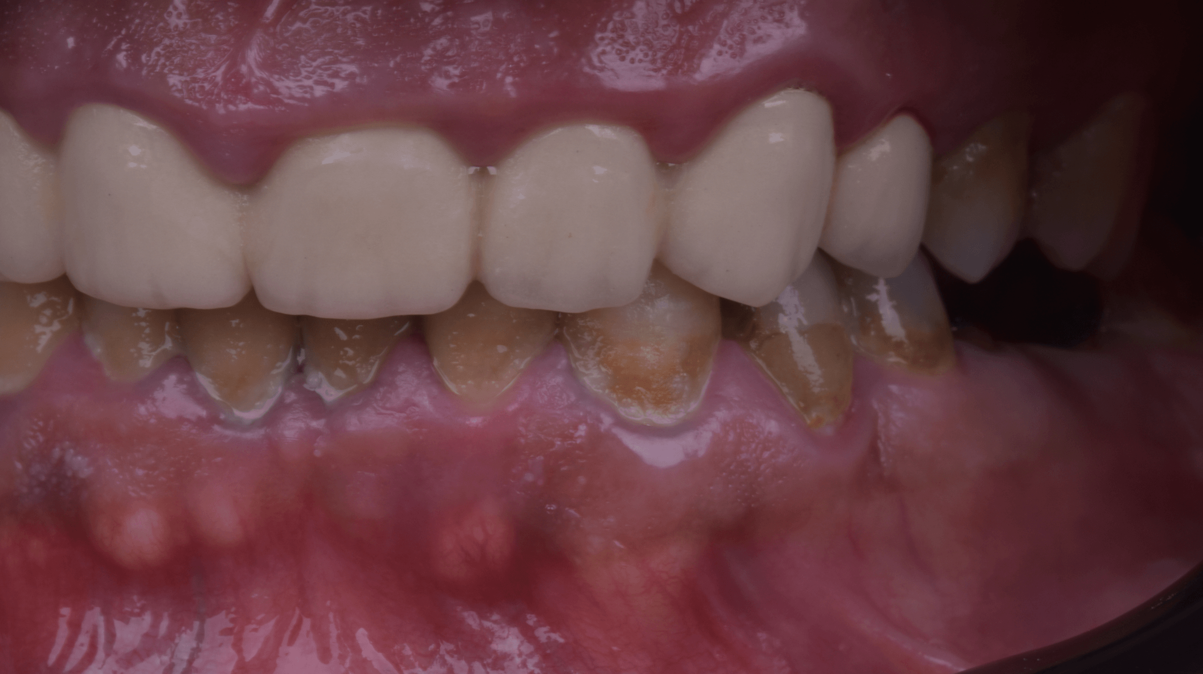 Restoring the front teeth — Before