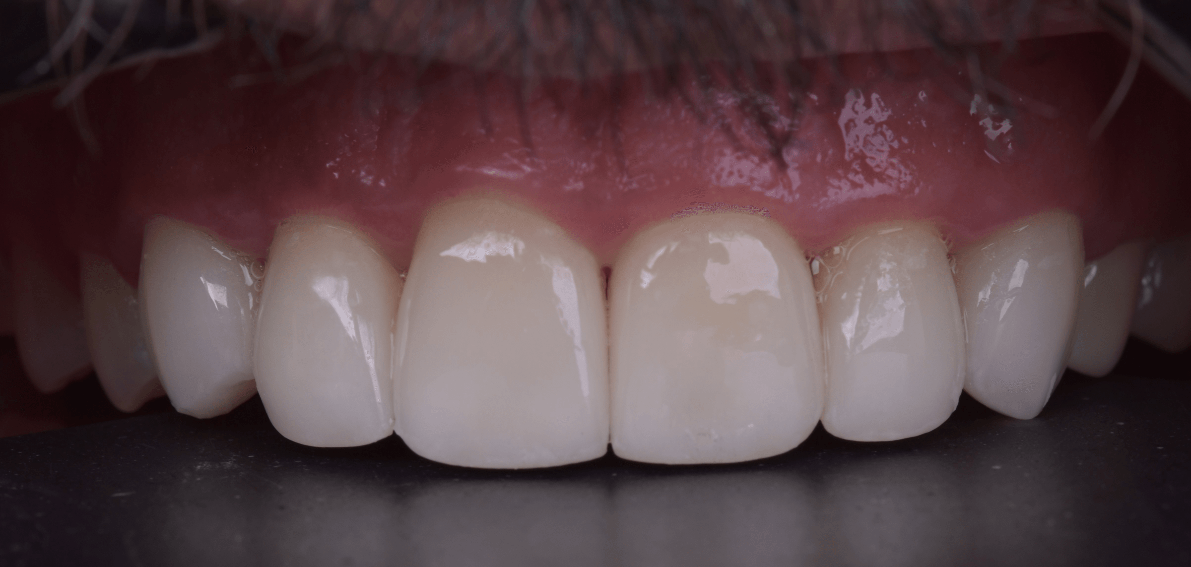 Refining the anterior smile — After