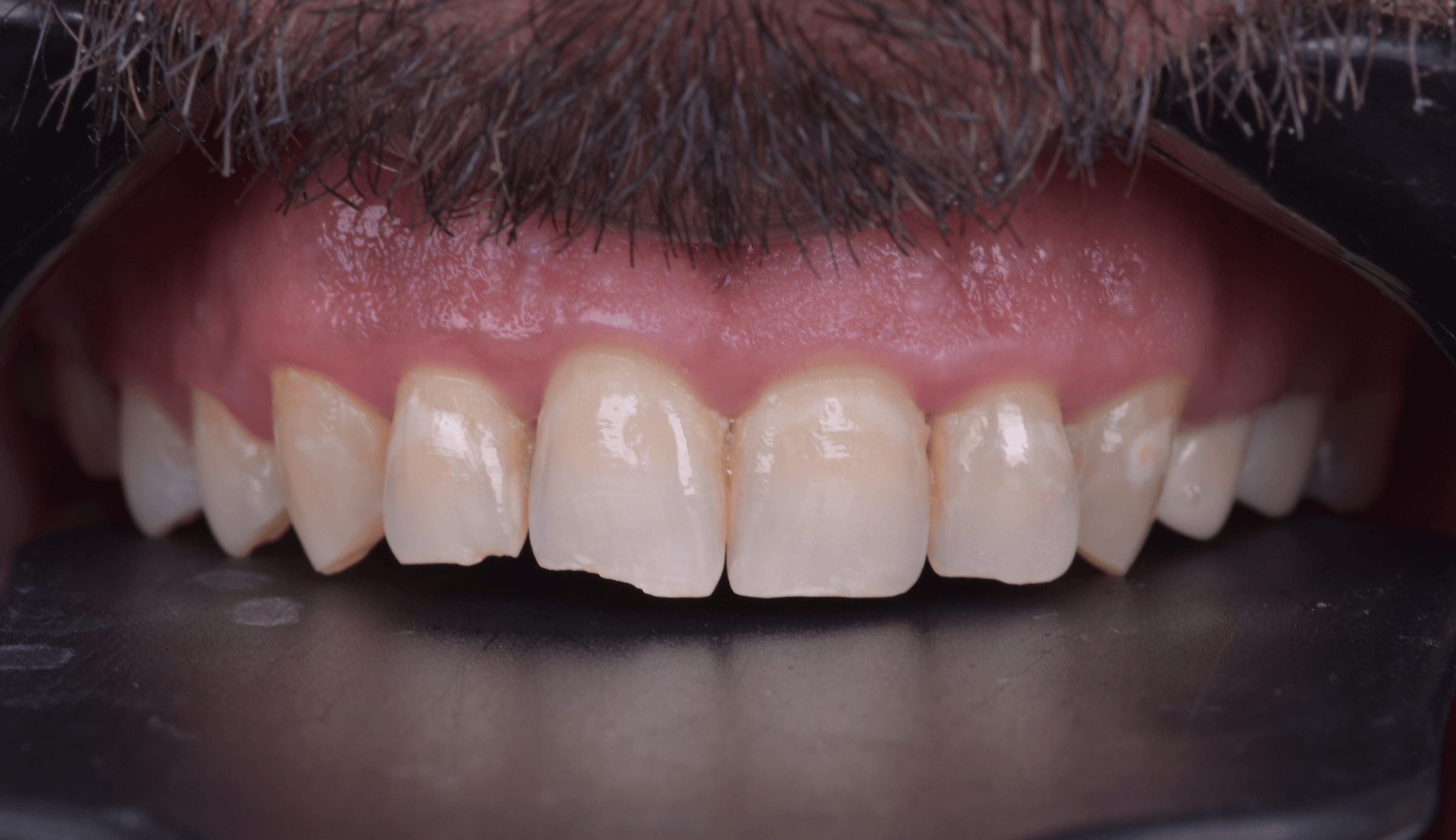 Refining the anterior smile — Before
