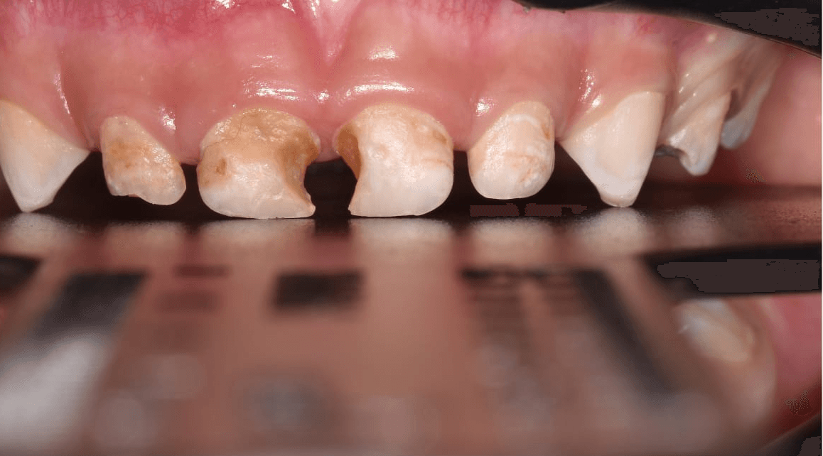 Anterior dental care — Case 01 — Before