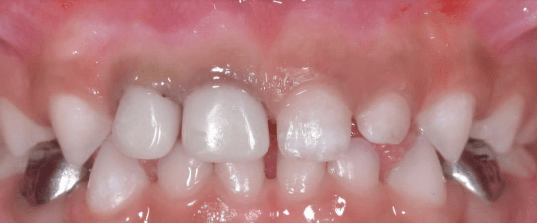 Anterior dental care — Case 04 — After