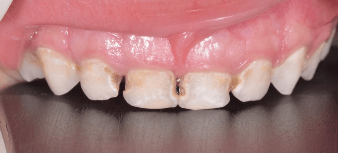 Anterior dental care — Case 05 — Before