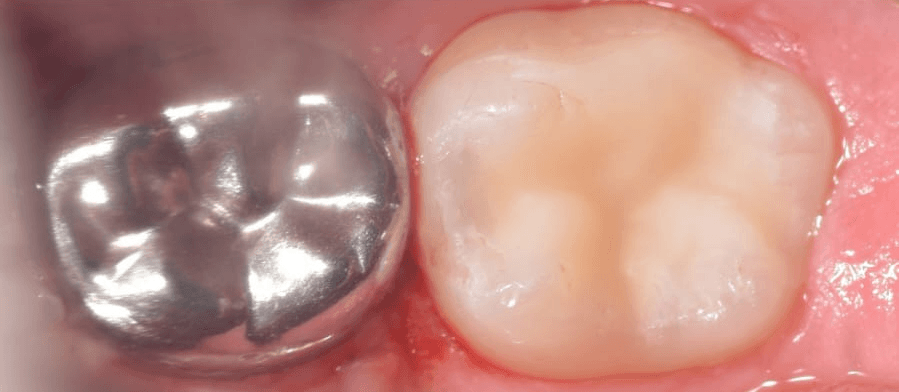 Posterior dental care — After