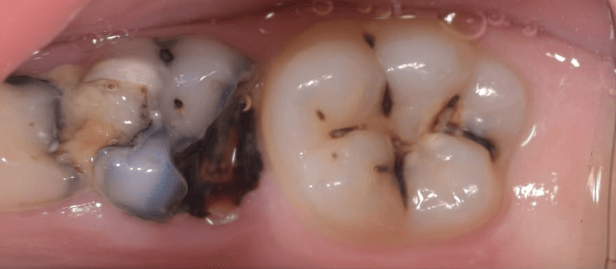 Posterior dental care — Before