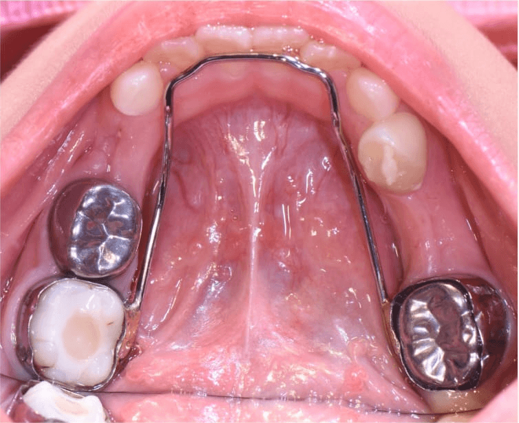Lower-arch dental care — After
