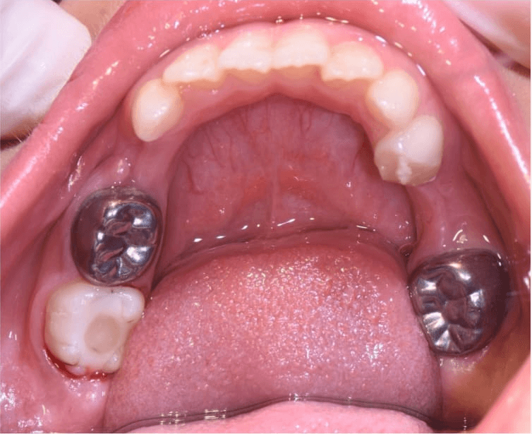 Lower-arch dental care — Before