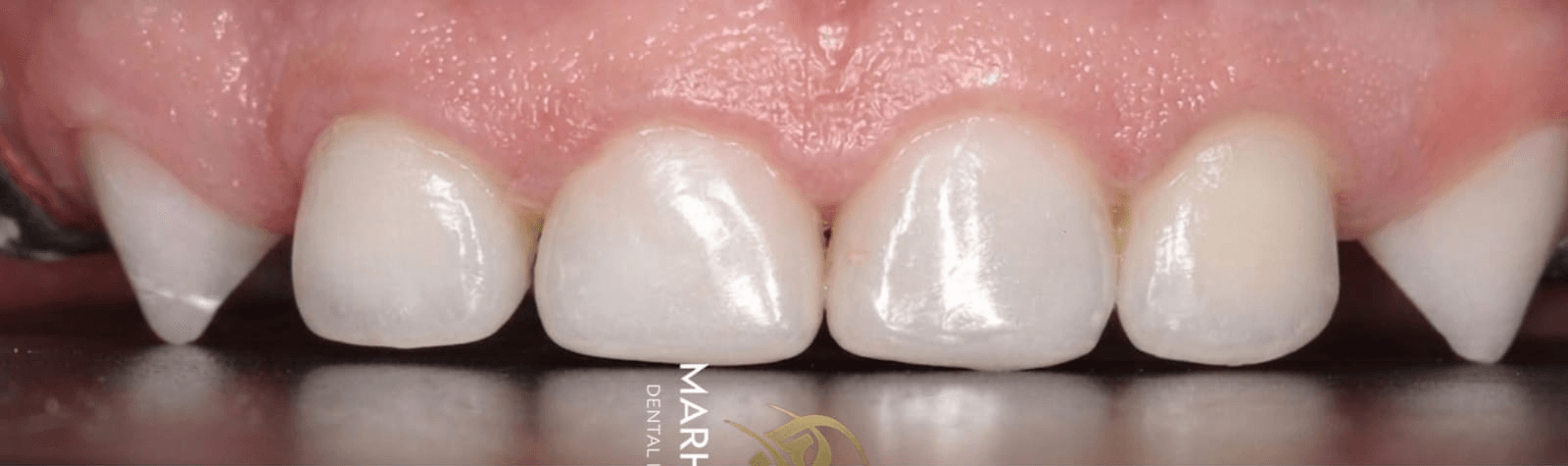 Anterior dental care — Case 08 — After