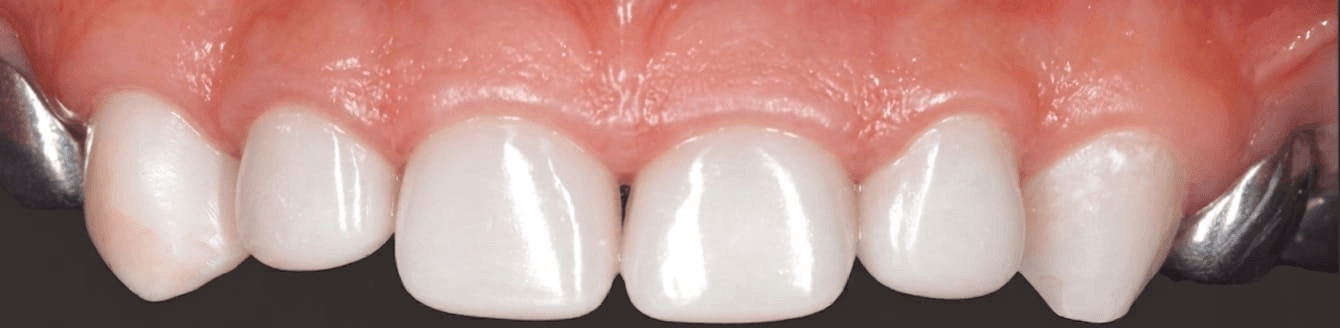 Anterior dental care — Case 09 — After