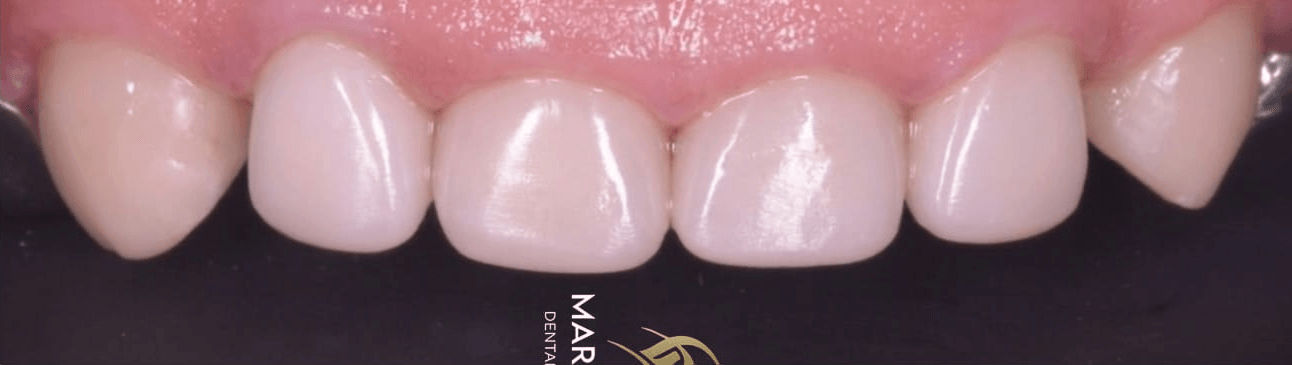 Anterior dental care — Case 10 — After