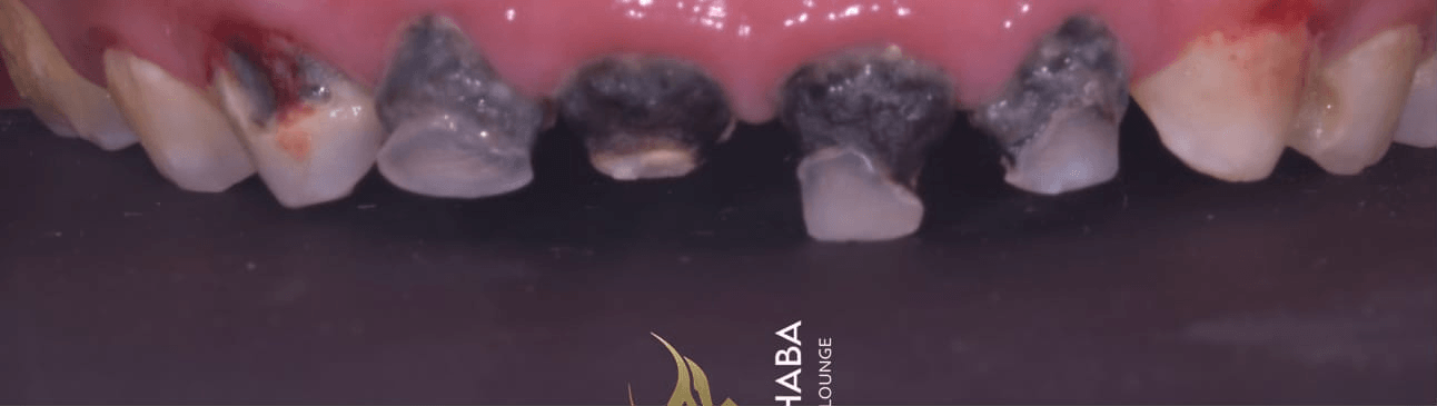 Anterior dental care — Case 10 — Before
