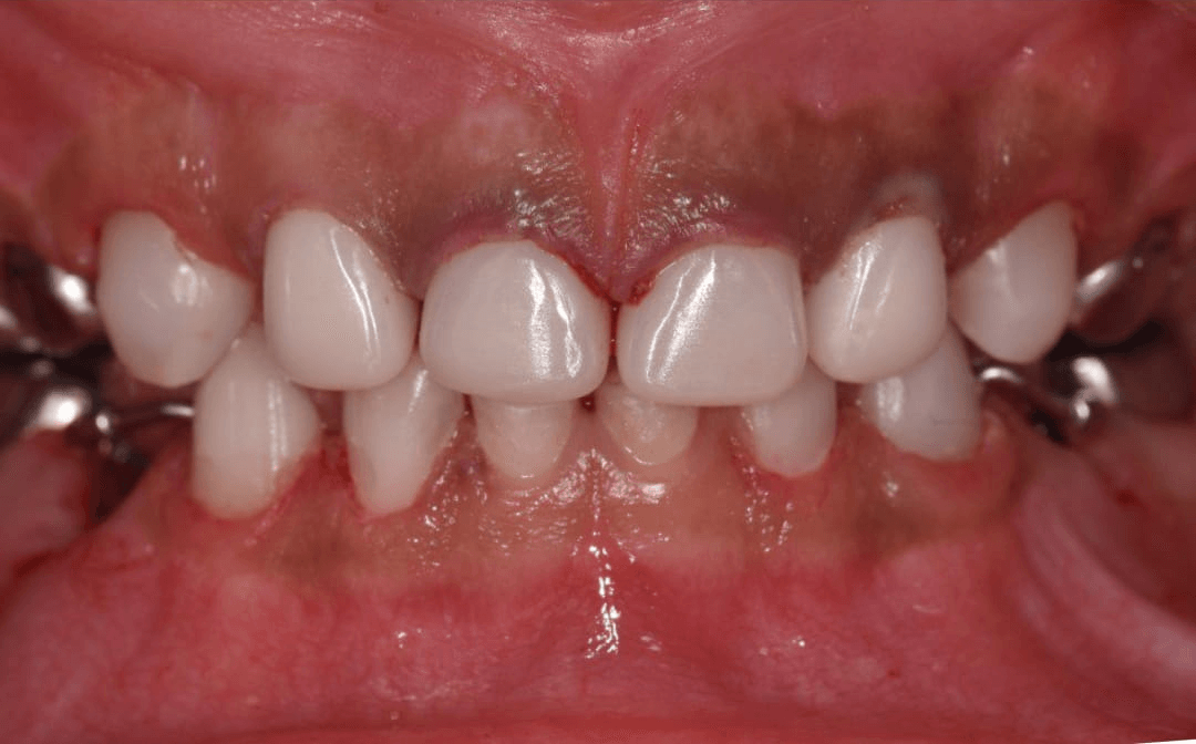 Anterior dental care — Case 11 — After