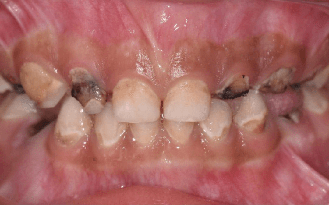Anterior dental care — Case 11 — Before