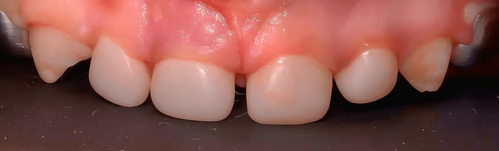 Anterior dental care — Case 12 — After