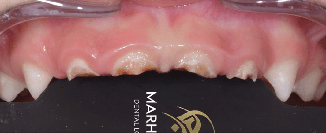 Anterior dental care — Case 13 — Before