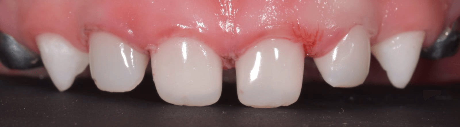 Anterior dental care — Case 14 — After