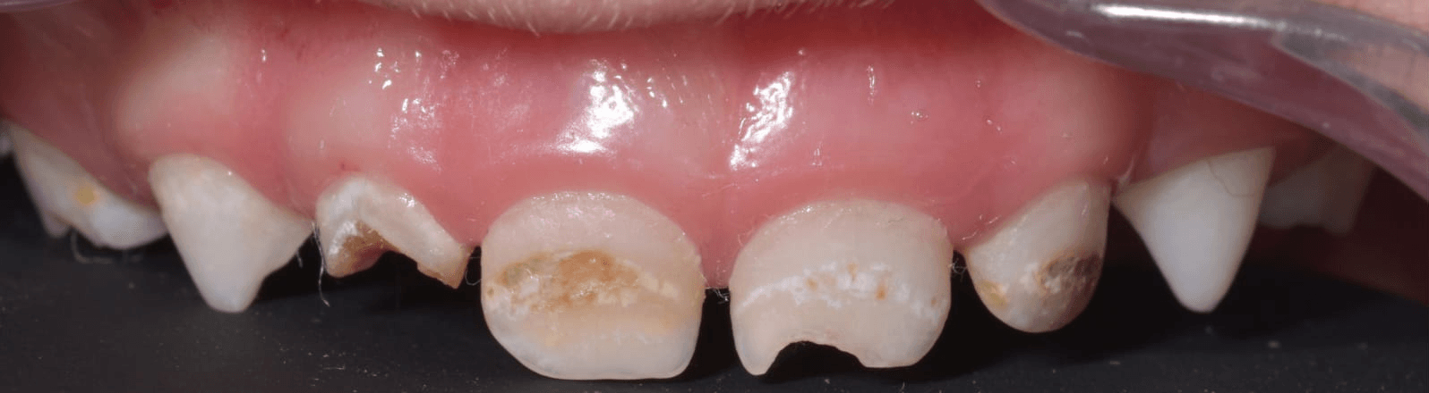 Anterior dental care — Case 14 — Before