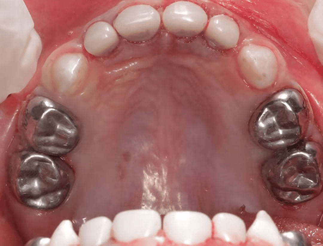 Upper-arch dental care — Case 16 — After