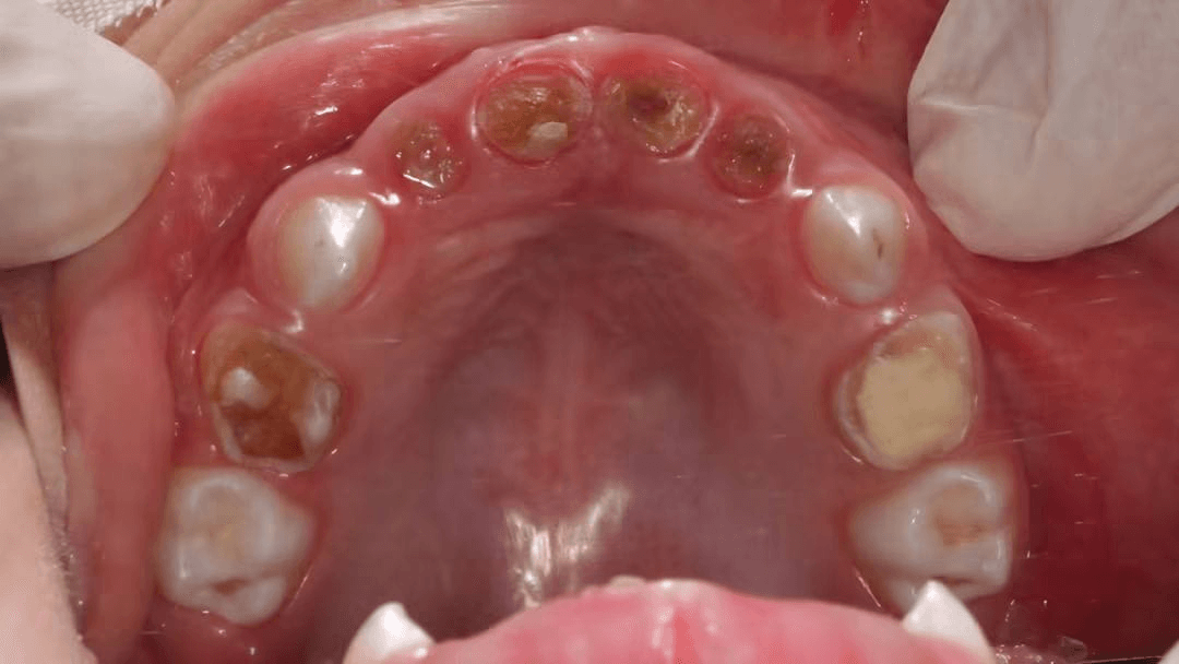 Upper-arch dental care — Case 16 — Before